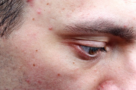 Dermatological disease acne pimples on the face of a man.