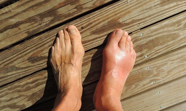 Gout in the feet.