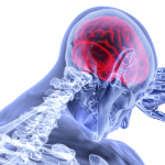 An inflammed brain. Viruses cause inflammation like Herpes simplex.