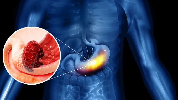 Stomach cancer. cancer attacking cell. stomach disease concept. 3d illustration, Helicobacter pylori