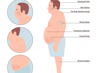 Cushing's syndrome. Excess cortisol production. Male figure with disease symptoms. Flat vector illustration.