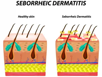 Seborrhea skin and hair. Dandruff seborrheic dermatitis. Eczema. Dysfunction of the sebaceous glands. Inflammatory skin disease. Anatomical structure. Infographics. Vector illustration